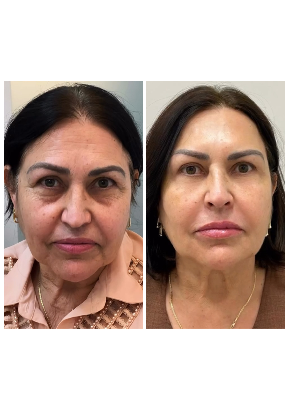 Antes-e-Depois-2.jpg